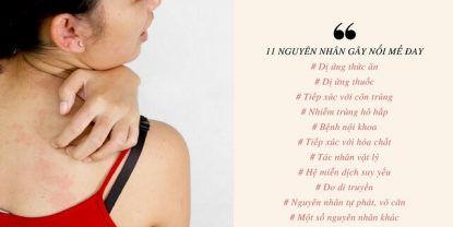 11 Nguyên nhân nổi mề đay mẩn ngứa ai cũng giật mình