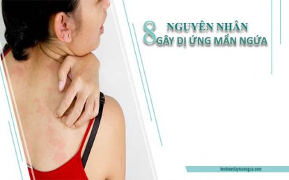 Nguyên nhân gây dị ứng da mẩn ngứa