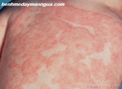 Chữa mề đay bằng các loại thảo dược có trong thuốc Đông y
