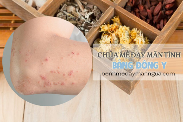 Vì sao chữa bệnh mề đay mãn tính bằng Đông y lại hiệu quả