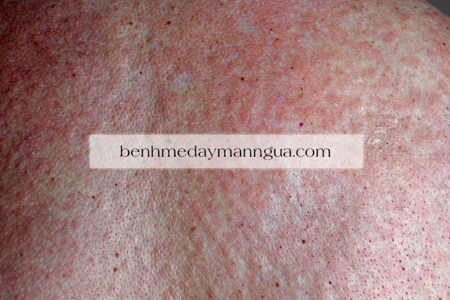 Điều trị bệnh mề đay mãn tính và bài trừ phong hàn