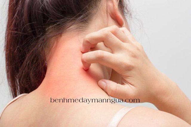 Chữa bệnh mề đay mãn tính kèm theo chứng ngứa ngáy về đêm