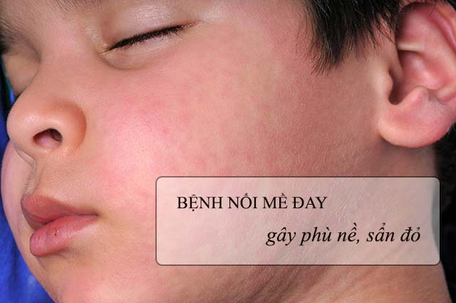 Bệnh nổi mề đay