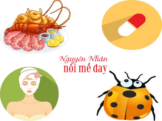 Nguyên nhân nổi mề đay