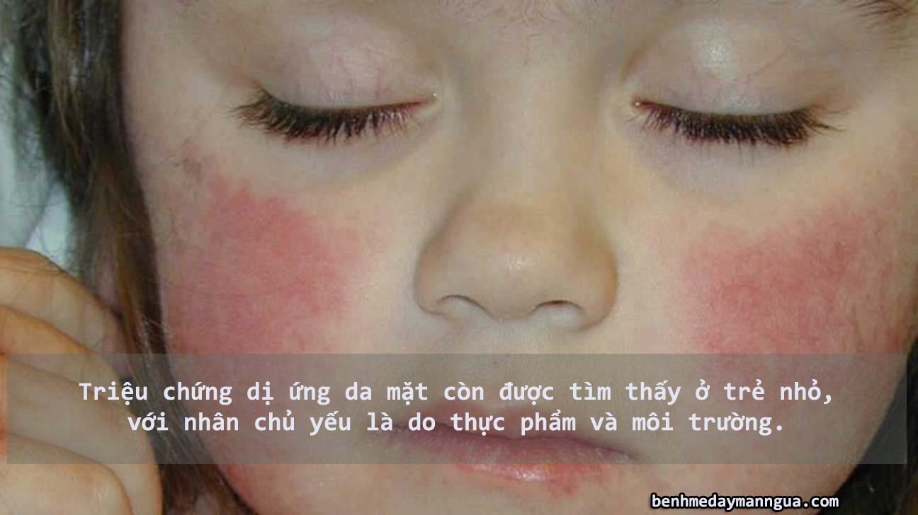 Triệu chứng dị ứng da mặt ở trẻ em 