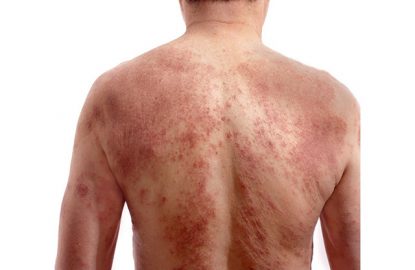Những thông tin cần biết về bệnh mề đay sắc tố