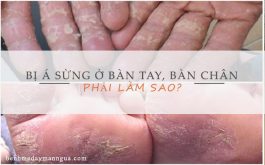 Bệnh á sừng ở bàn tay bàn chân