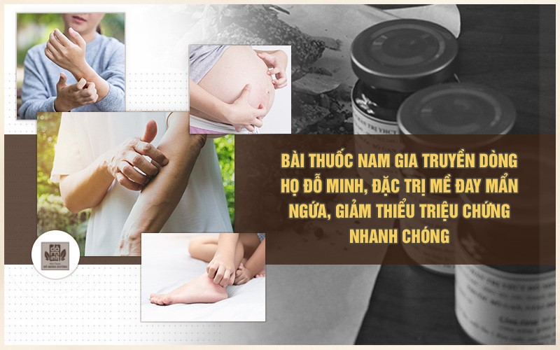 Hết mề đay mẩn ngứa nhờ bài thuốc Đỗ Minh Đường