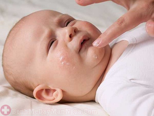 Cách chữa viêm da tiếp xúc ở trẻ sơ sinh an toàn