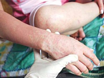 Xin hỏi sốt phát ban đỏ có lây không? Cách phòng tránh
