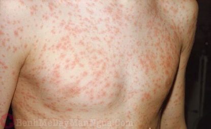 Làm sao khi bị nổi phát ban đỏ nhưng không sốt? Có nguy hiểm không
