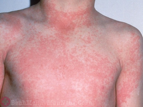 Làm sao khi bị nổi phát ban đỏ nhưng không sốt? Có nguy hiểm không