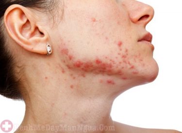 Lời giải đáp dị ứng da mặt bao lâu thì khỏi? có tự khỏi không?