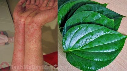 Mẹo hay trị dị ứng da tay, chân nhanh chóng từ dân gian
