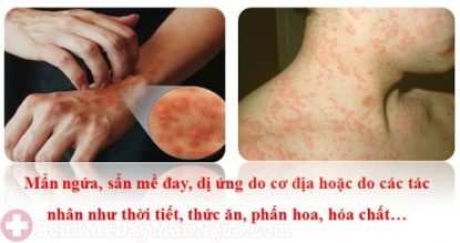 Vì sao bị bệnh phát ban đỏ trên da? Làm thế nào để chữa trị đúng cách?