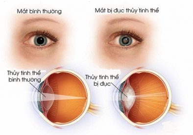 6 biến chứng bệnh Eczema không nên coi thường