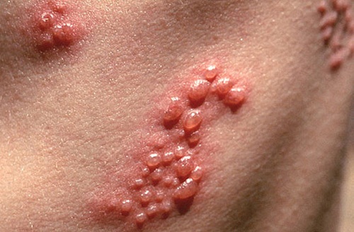6 chứng bệnh khiến da nổi mẩn đỏ không ngứa thường gặp