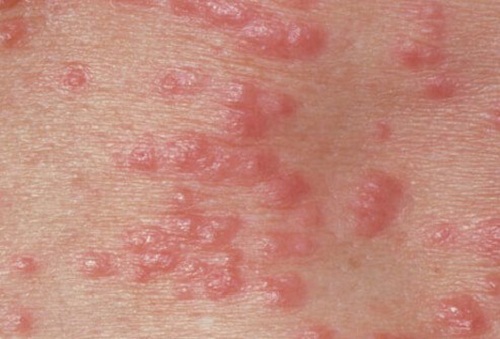 6 chứng bệnh khiến da nổi mẩn đỏ không ngứa thường gặp