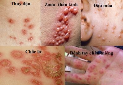 6 chứng bệnh khiến da nổi mẩn đỏ không ngứa thường gặp