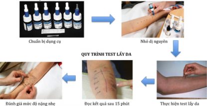 Bị dị ứng thuốc kháng sinh bao lâu thì hết, nên uống thuốc gì?