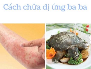 Dị ứng ba ba và cách xử lý nhanh chóng ngay tại chỗ