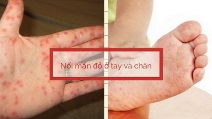 Đột nhiên xuất hiện nổi mẩn đỏ ở lòng bàn tay và chân là bệnh gì?