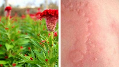 Dùng hoa mào gà chữa bệnh mề đay liệu có thực sự tốt