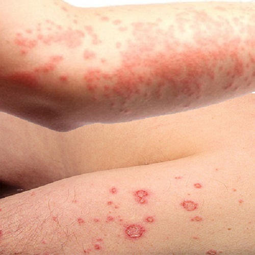 Giải đáp bệnh eczema có nguy hiểm không?