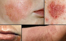 Giải đáp bệnh eczema có nguy hiểm không?