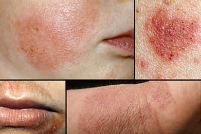 Giải đáp bệnh eczema có nguy hiểm không?