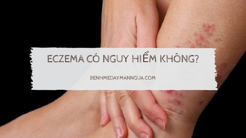 Giải đáp bệnh eczema có nguy hiểm không?