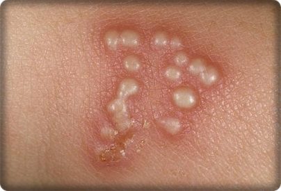 Hiện tượng da nổi mẩn đỏ có mủ có nguy hiểm không?