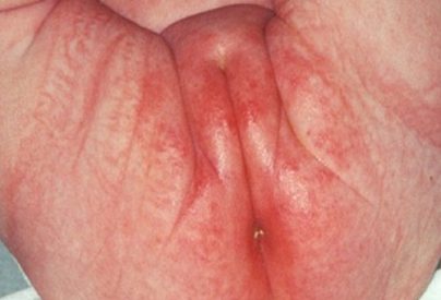 Khi trẻ bị nổi mẩn đỏ ở bộ phận sinh dục nên làm gì?