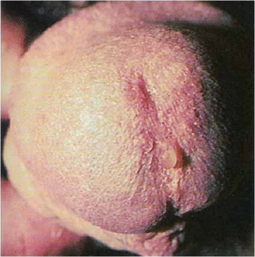 Ngứa nổi mẩn đỏ ở bộ phận sinh dục nam là bệnh gì và cách khắc phục