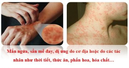 Nguyên nhân và triệu chứng bệnh phong ngứa không nên xem nhẹ