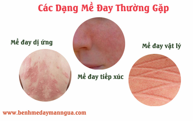 Các dạng nổi mề đay thường gặpCác dạng nổi mề đay thường gặp