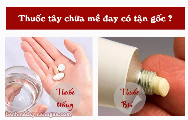 Trị nổi mề đay bằng thuốc Tây