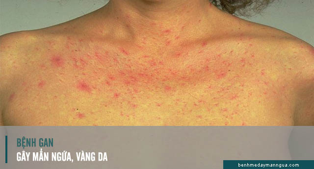 mẩn ngứa, vàng da do bệnh gan