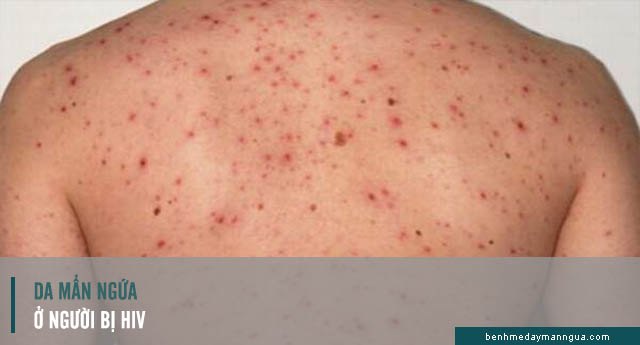 người bị HIV gây mẩn ngứa ngoài da