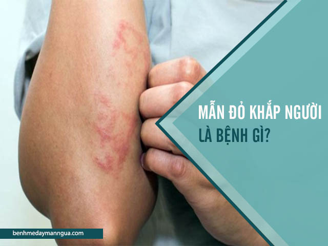 bệnh mẩn ngứa