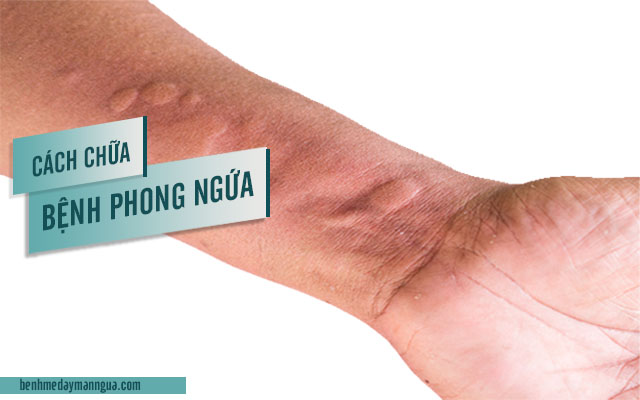 cách chữa bệnh phong ngứa
