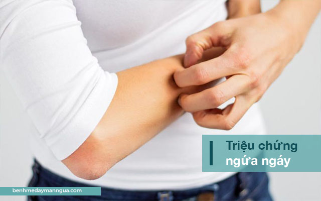 ngứa ngáy là triệu chứng điển hình của phong ngứa