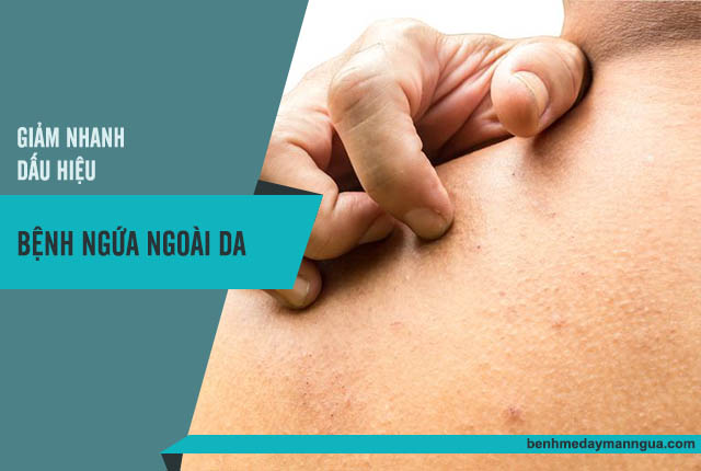 thuốc chữa bệnh ngứa ngoài da