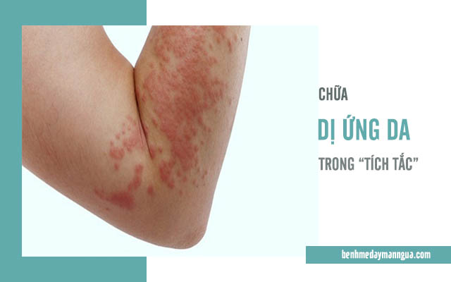 cách chữa dị ứng da đơn giản