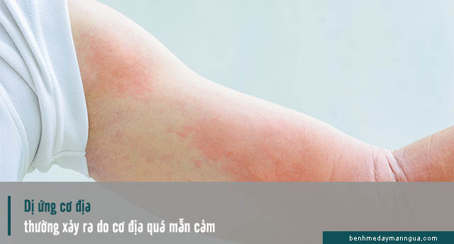 dị ứng cơ địa do cơ địa quá mẫn cảm