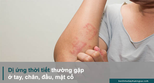 vị trí mẩn ngứa, mề đay do dị ứng thời tiết