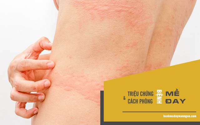 triệu chứng mề đay mẩn ngứa và phòng ngừa mề đay mẩn ngứa