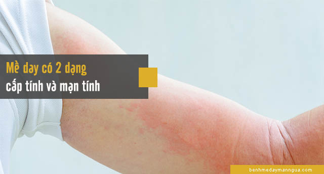 các dạng mề đay thường gặp