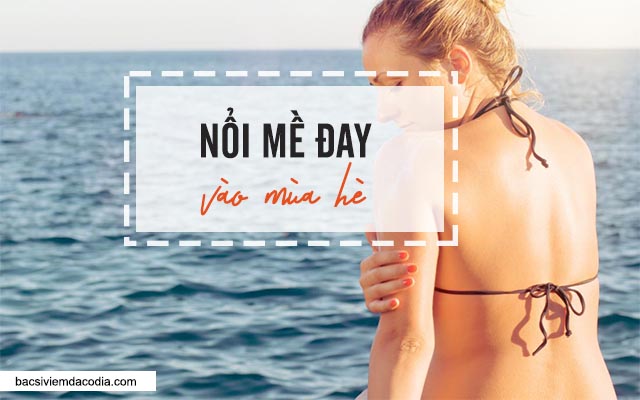 nổi mề đay vào mùa hè