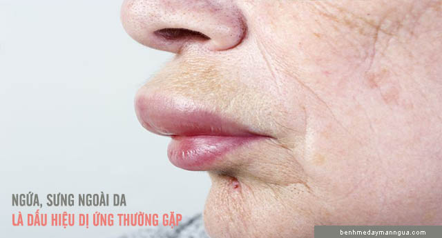 dấu hiệu dị ứng tôm cua